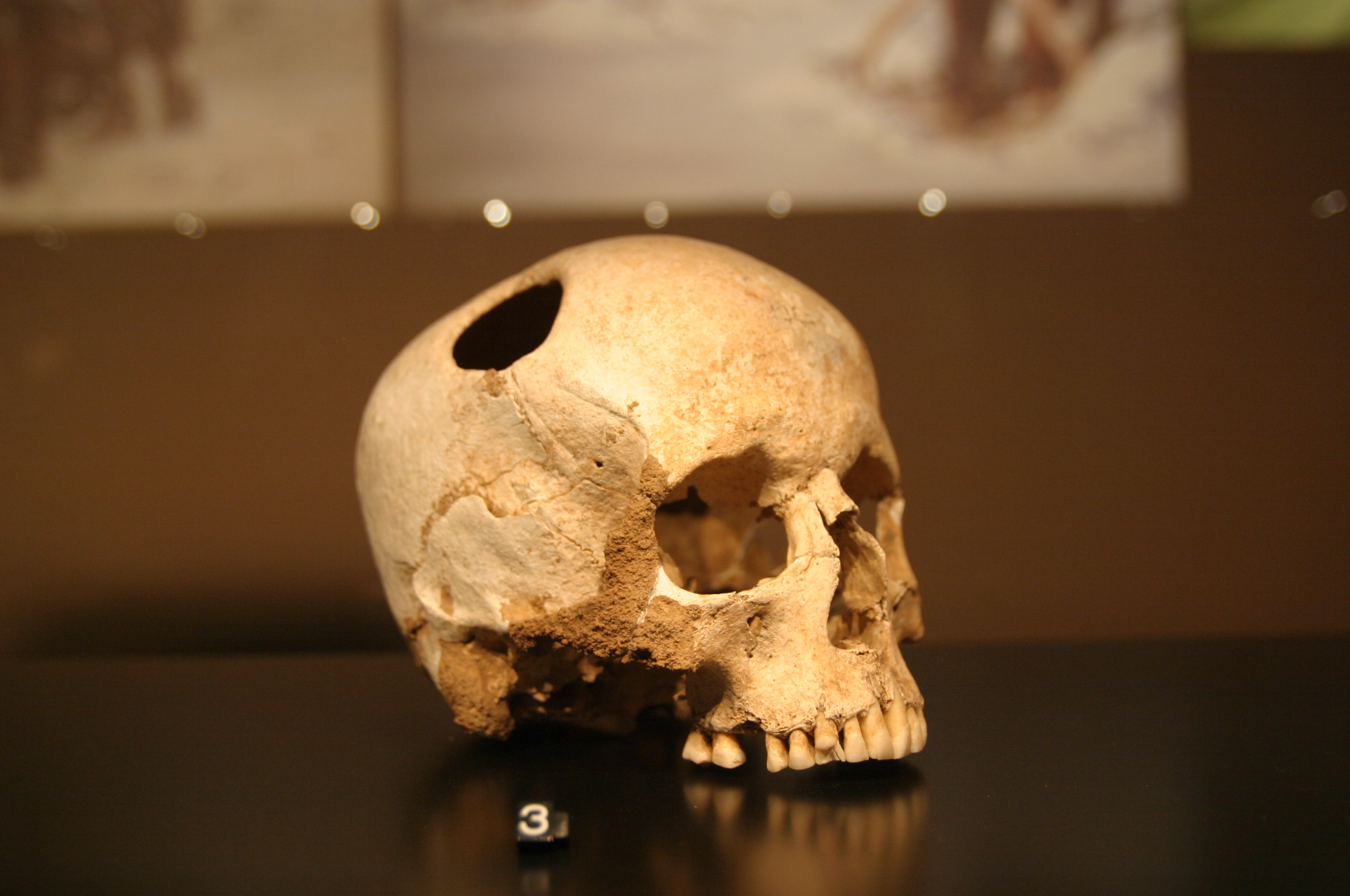 Historischer Schädelfund mit Trepanationsöffnung